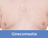 ginecomastia